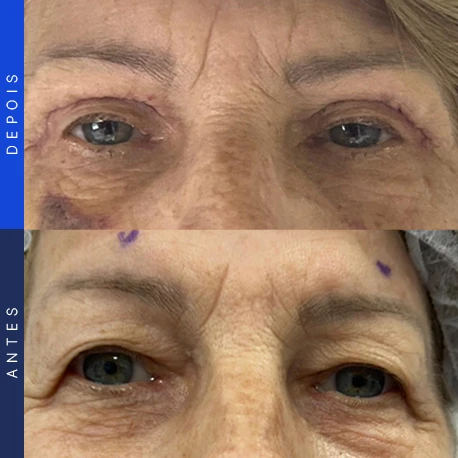 Antes e depois de blefaroplastia, caso 1, Clínica Ophtalmus