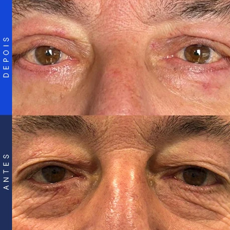 Antes e depois de blefaroplastia, caso 10, Clínica Ophtalmus