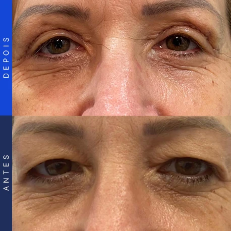 Antes e depois de blefaroplastia, caso 2, Clínica Ophtalmus