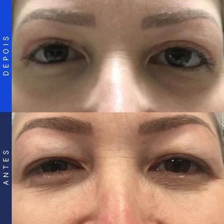 Antes e depois de blefaroplastia, caso 3, Clínica Ophtalmus