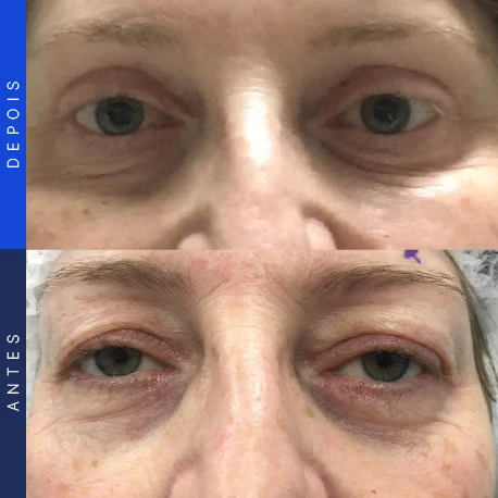 Antes e depois de blefaroplastia, caso 4, Clínica Ophtalmus