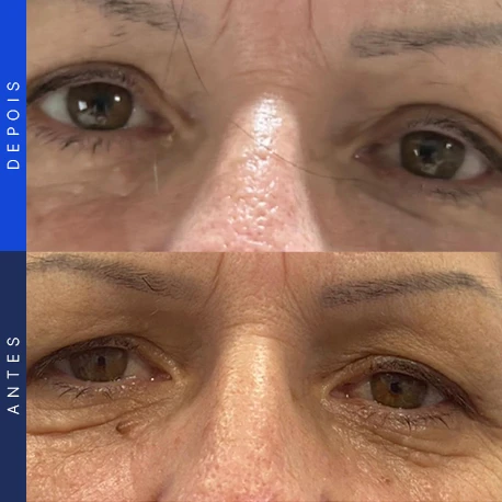 Antes e depois de blefaroplastia, caso 5, Clínica Ophtalmus