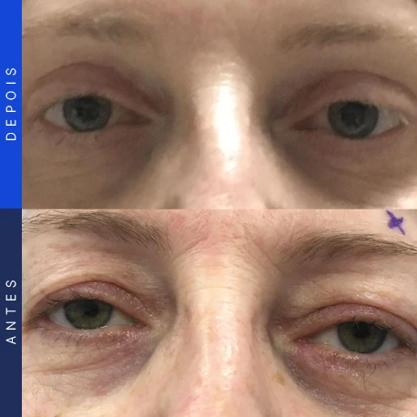 Antes e depois de blefaroplastia, caso 6, Clínica Ophtalmus