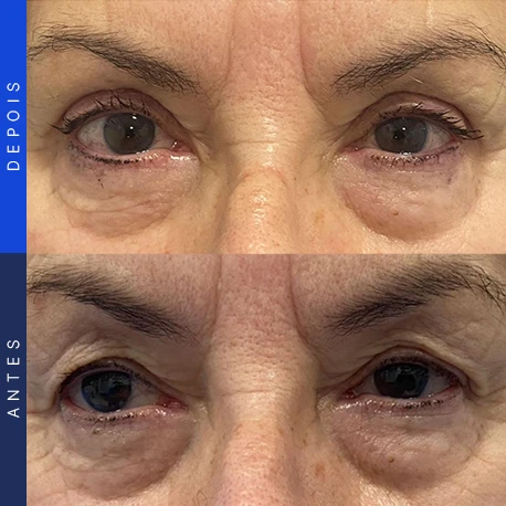 Antes e depois de blefaroplastia, caso 7, Clínica Ophtalmus
