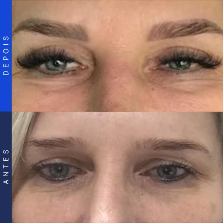 Antes e depois de blefaroplastia, caso 8, Clínica Ophtalmus