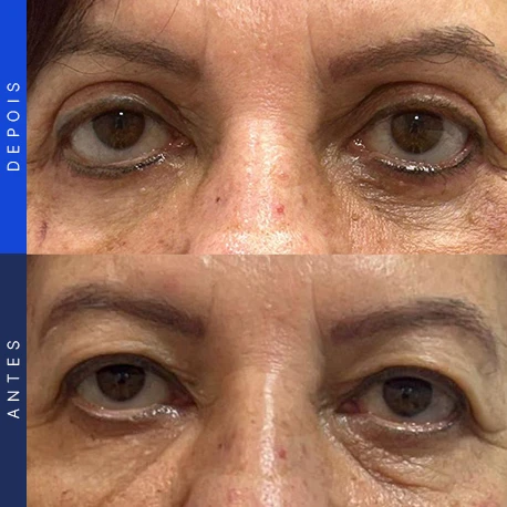 Antes e depois de blefaroplastia, caso 9, Clínica Ophtalmus